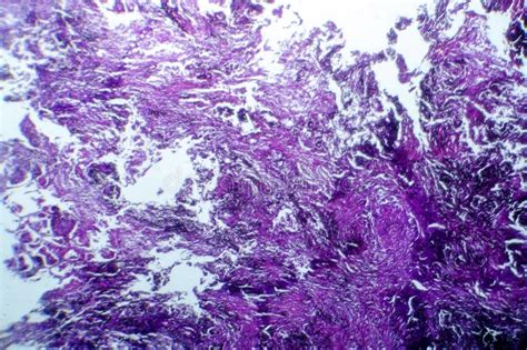 Photomicrograph of Lung Tissue with Silicosis Pathology Under a ...