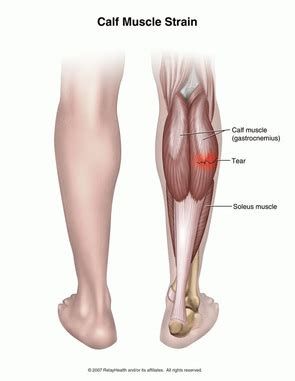 Calf Muscle | Muscle Strain | Physio for Calf