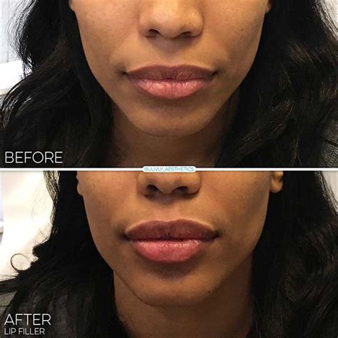 Juvederm Ultra Plus Before And After Lips | Lipstutorial.org