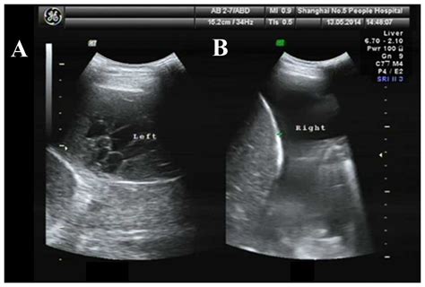 Efficacy of ultrasound-guided thoracentesis catheter drainage for pleural effusion