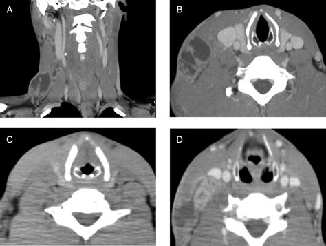 Relapse of cervical tuberculous lymphadenitis immediately after ...