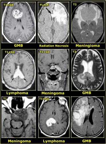 Brain Mri Scan Tumor