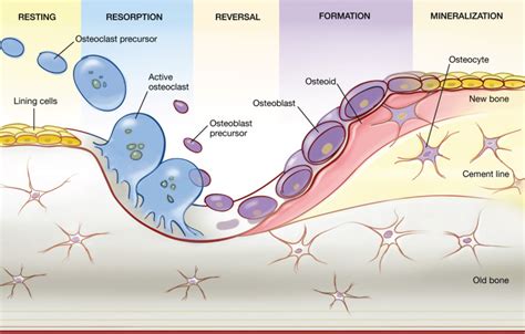 Paget’s Disease | Radiology Key