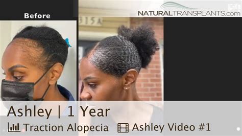 Traction Alopecia Regrowth Results: One Year Hair Transplant Journey | Dr. Blumenthal (Ashley ...