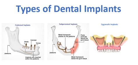 Tooth Implant Types