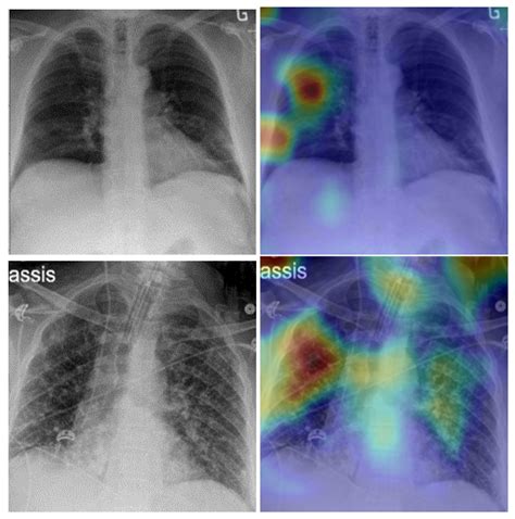 Viruses | Free Full-Text | Explainable COVID-19 Detection Based on Chest X-rays Using an End-to ...