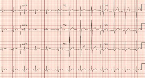 Brugada Syndrome Ekg Findings - Captions Hunter