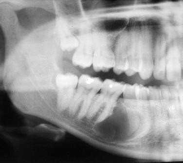 Odontogenesis, Odontogenic Cysts, and Odontogenic Tumors | Ento Key