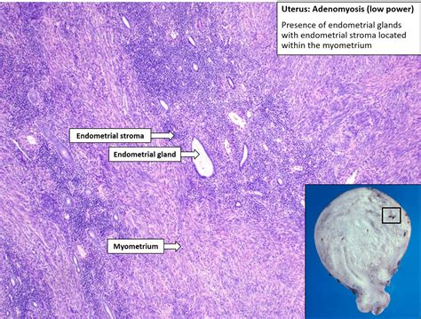 Adenomyosis Histology | SexiezPix Web Porn