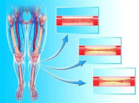 Critical Limb Ischemia - TRA Endovascular