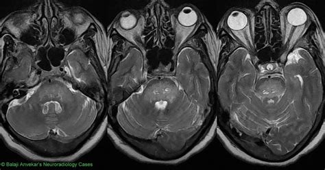 Neuroradiology Cases: Central Pontine Myelinolysis