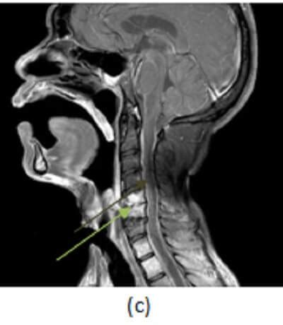 Discitis/Osteomyelitis with Epidural Phlegmon - DocNeuro