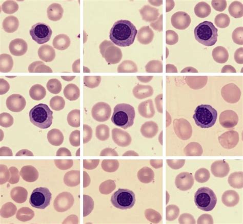 Nucleated red blood cell (Normoblast) - DocCheck