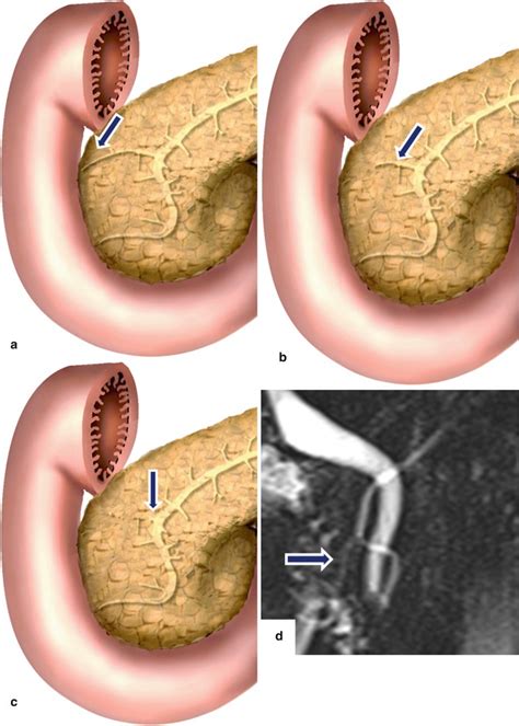 Pancreatic Duct Anatomy Radiology