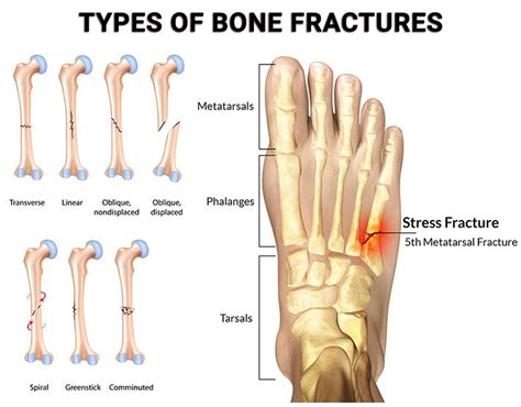 Foot & Ankle Fractures - Premier Podiatry: Velimir Petkov, DPM: Podiatrists: Clifton, NJ