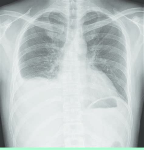 Chest radiograph shows costophrenic angle blunting at the right... | Download Scientific Diagram