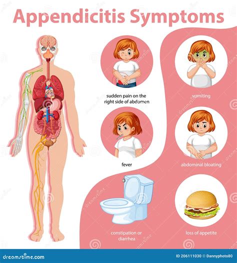 Appendicitis Symptoms Infographic Stock Illustration Download Image | Porn Sex Picture