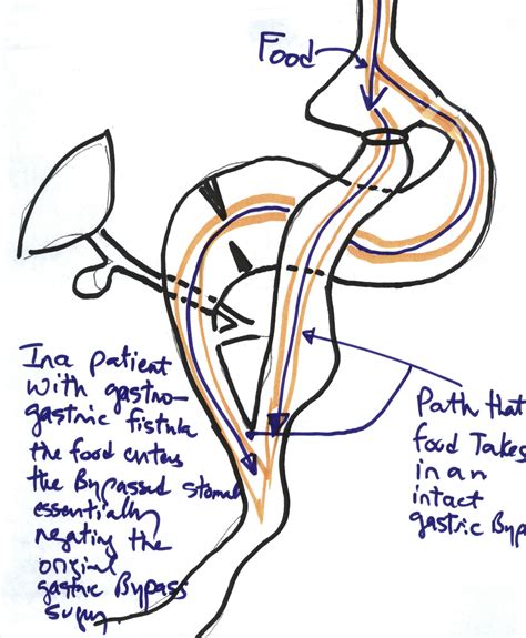 Gastro-gastric fistula after gastric bypass operation - DSSurgery