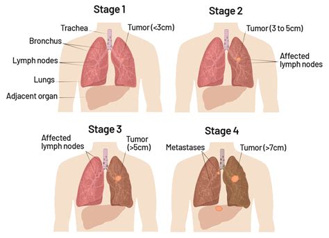 Lung Cancer Symptoms, Risk Factors, Diagnosis, and Treatment | Saint John’s Cancer Institute