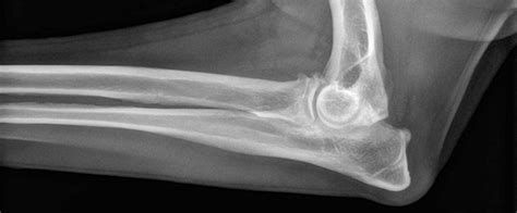 ELBOW DYSPLASIA | Buyxraysonline