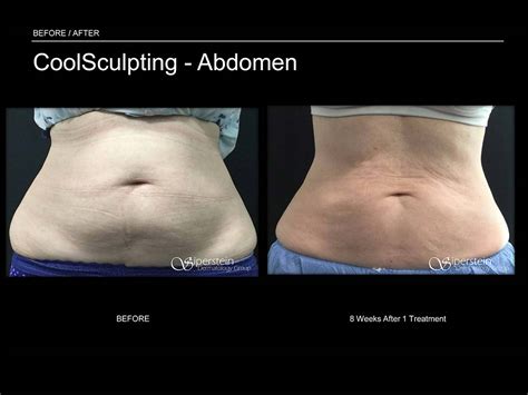 Before & After Photos Of Coolsculpting Treatment Results