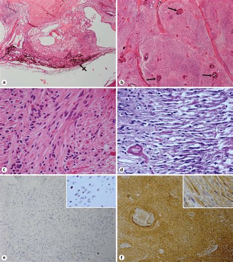 Episclera Histology