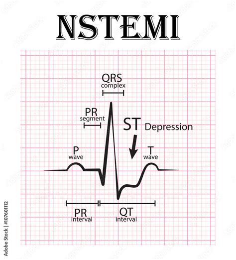 ECG of non ST elevation myocardial infarction (NSTEMI) and detail of ECG ( P wave , PR segment ...