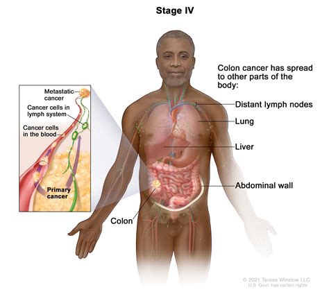 Colon Cancer Treatment (PDQ®) - NCI