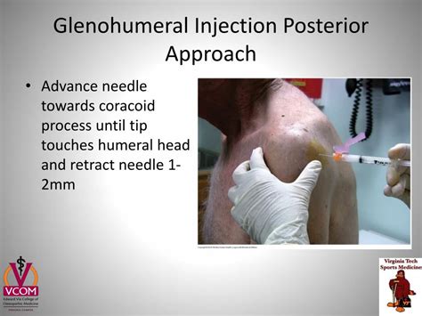 Glenohumeral Injection Posterior Approach