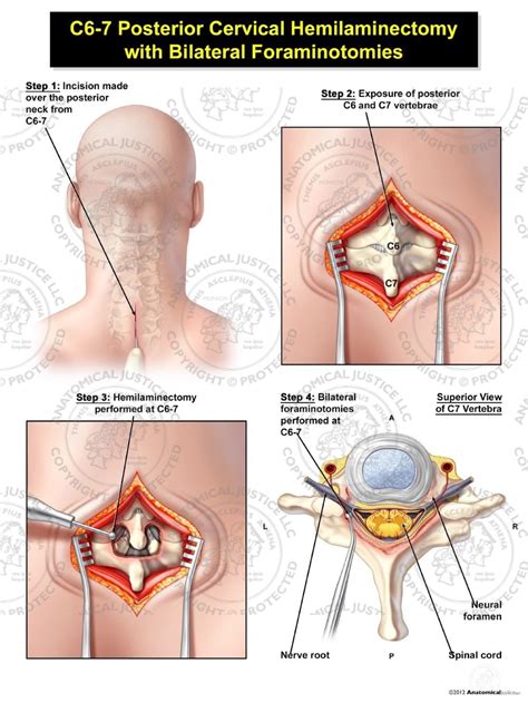 C6-7 Posterior Cervical Hemilaminectomy with Bilateral Foraminotomies