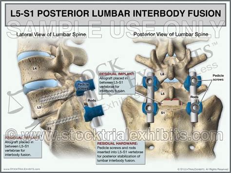 L5-S1 Posterior Lumbar Interbody Fusion (PLIF) | Spinal fusion surgery ...