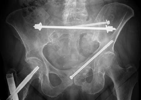 Minimal-invasive stabilization of anterior pelvic ring fractures with retrograde transpubic ...