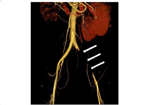 Occlusion of the left common and internal iliac artery (arrows) is ...