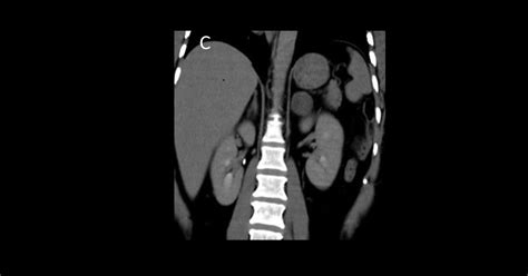 Left Adrenal Adenoma (Lipid rich) - Manal's Classroom