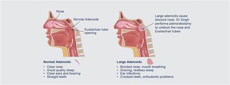 Adenoids Surgery