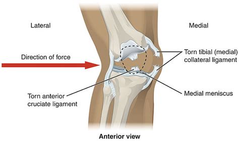 Knee Injuries from Car and Motorcycle Accidents: Settlements and More