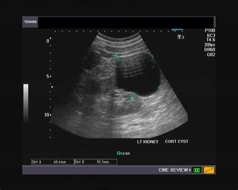 Ultrasound and Color Doppler videos: An Unusual cortical cyst of kidney- ultrasound video: