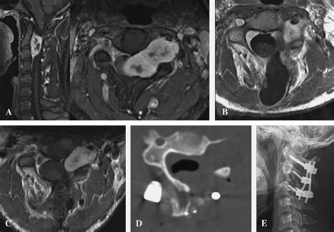 Giant Invasive Spinal Schwannoma: Its Clinical Features and Surgical Management | Neurosurgery Blog