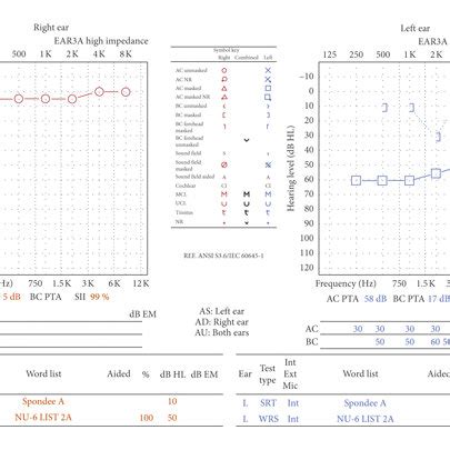 Tympanogram showing type A for the right ear and type B for the left ear. | Download Scientific ...