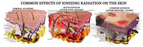 Radiation burn