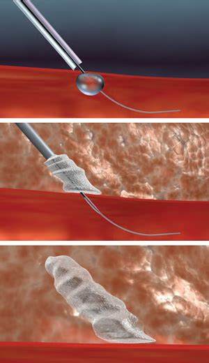 Mynx Cadence Vascular Closure Device Released | Medgadget