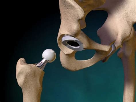 DePuy Hip Replacement Lawsuit South Florida