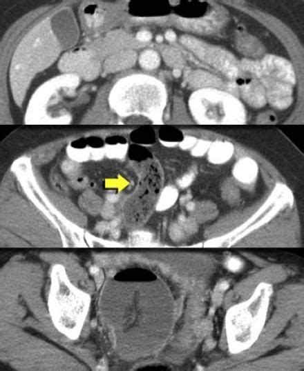 The Radiology Assistant : Closed Loop Obstruction in Small bowel obstruction | Small bowel ...