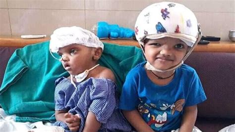 1 of conjoined twins separated in India’s first craniopagus surgery ...