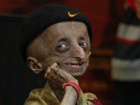 Nihal, face of rare genetic disorder progeria in India, dies at 15 | Mumbai news - Hindustan Times