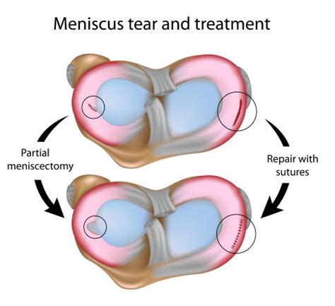 Meniscus tear: Surgery, rehabilitation, costs | Joint-surgeon.com