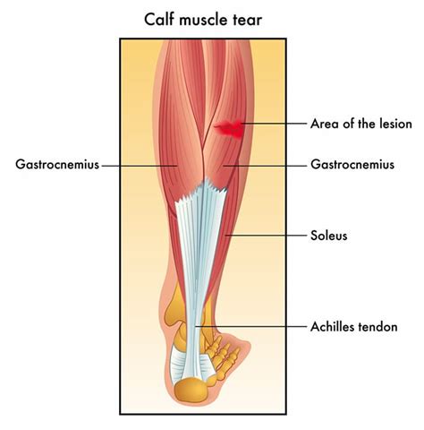 Gastrocnemius Tear(Calf Muscle Tear) - Upswing Health | Upswing Health