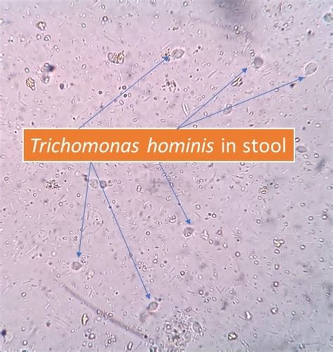 Trichomonas Hominis In Stool