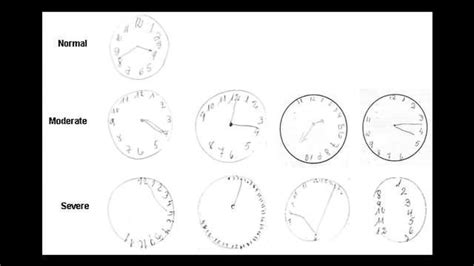 Researchers Assess Usefulness of Clock Drawing Cognitive Test in ...