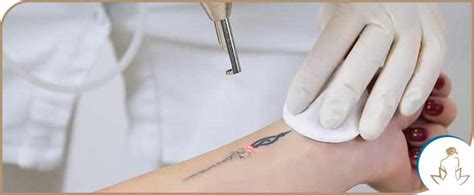 PicoWay Laser Tattoo Removal Specialist Near Me in Saint Clair Shores, MI